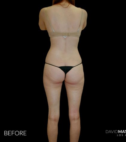High Def Liposuction Female Before & After Patient #2705
