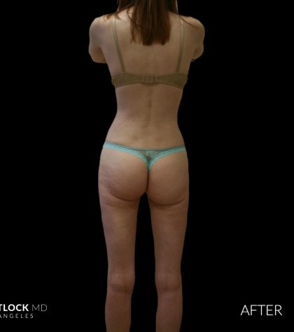 High Def Liposuction Female Before & After Patient #2705