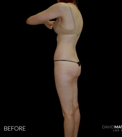 High Def Liposuction Female Before & After Patient #2705