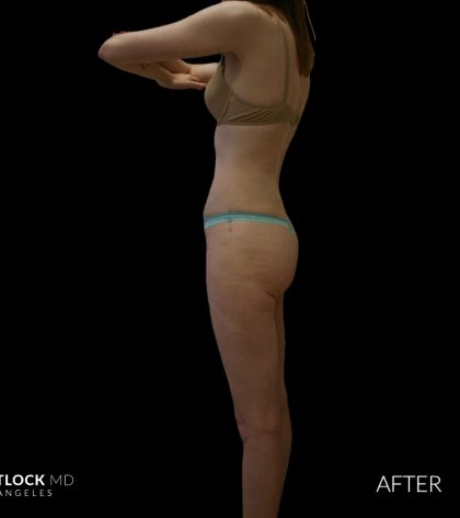 High Def Liposuction Female Before & After Patient #2705