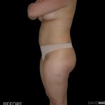 High Def Liposuction Female Before & After Patient #2706