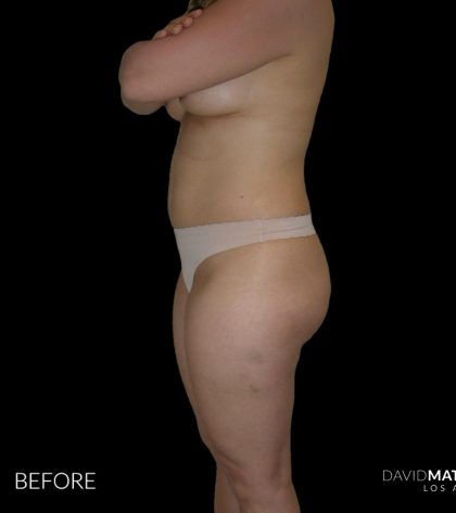 High Def Liposuction Female Before & After Patient #2706