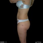 High Def Liposuction Female Before & After Patient #2706