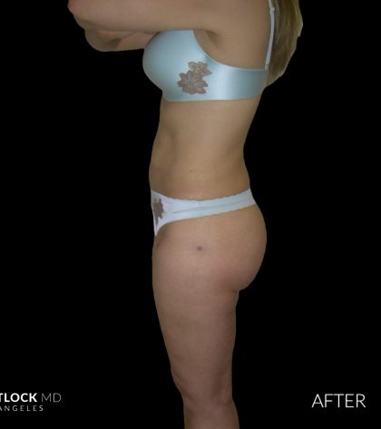High Def Liposuction Female Before & After Patient #2706