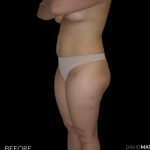 High Def Liposuction Female Before & After Patient #2706