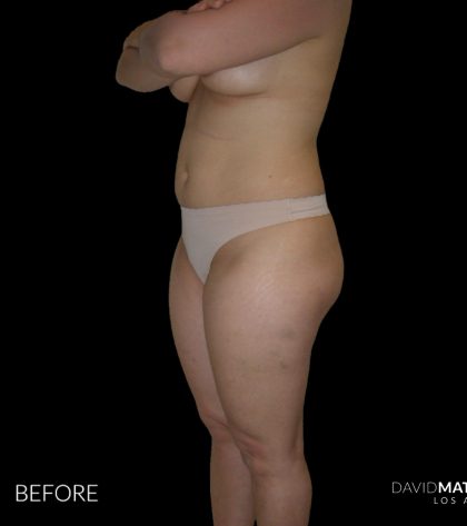 High Def Liposuction Female Before & After Patient #2706