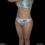 High Def Liposuction Female Before & After Patient #2706