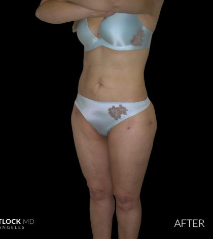 High Def Liposuction Female Before & After Patient #2706