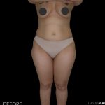High Def Liposuction Female Before & After Patient #2706