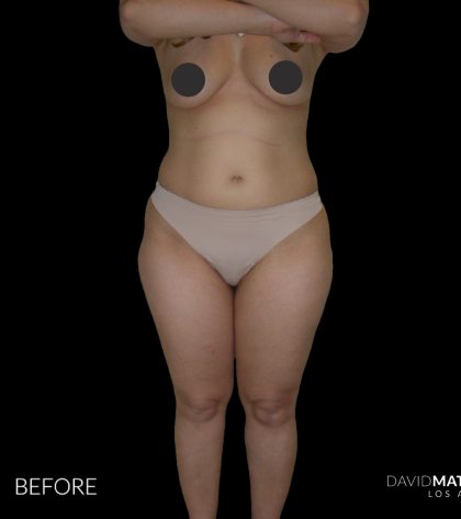 High Def Liposuction Female Before & After Patient #2706