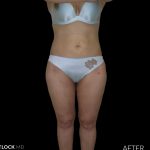 High Def Liposuction Female Before & After Patient #2706