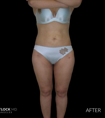 High Def Liposuction Female Before & After Patient #2706