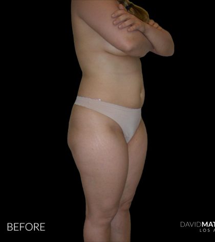 High Def Liposuction Female Before & After Patient #2706