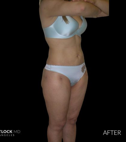 High Def Liposuction Female Before & After Patient #2706
