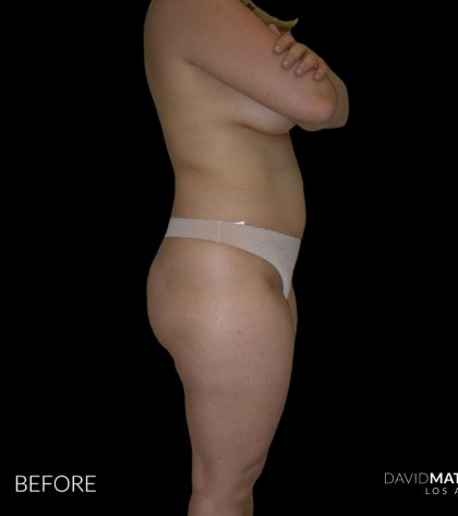 High Def Liposuction Female Before & After Patient #2706