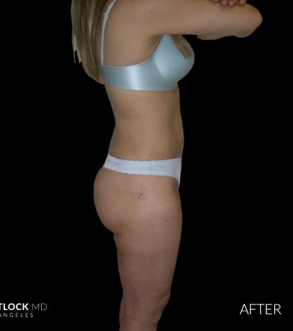 High Def Liposuction Female Before & After Patient #2706