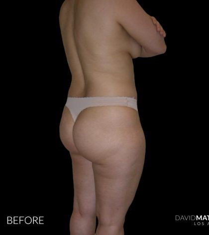 High Def Liposuction Female Before & After Patient #2706