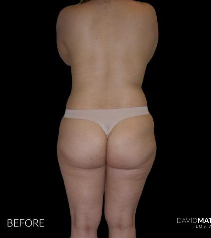 High Def Liposuction Female Before & After Patient #2706