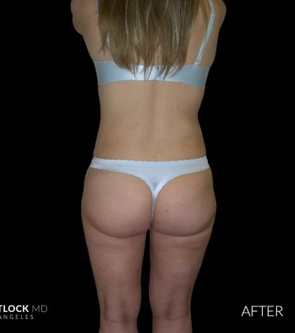 High Def Liposuction Female Before & After Patient #2706
