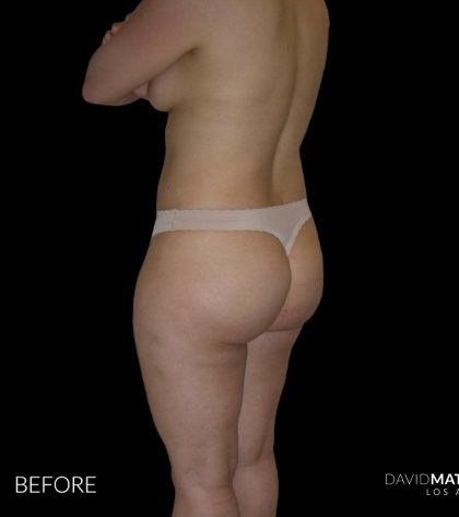 High Def Liposuction Female Before & After Patient #2706