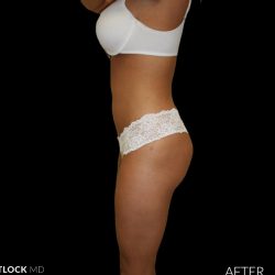 High Def Liposuction Female Before & After Patient #2707