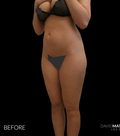High Def Liposuction Female Before & After Patient #2708