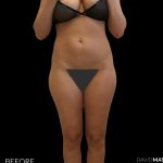 High Def Liposuction Female Before & After Patient #2708