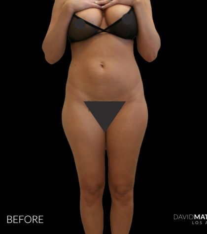 High Def Liposuction Female Before & After Patient #2708