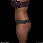 High Def Liposuction Female Before & After Patient #2709