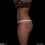 High Def Liposuction Female Before & After Patient #2709