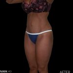 High Def Liposuction Female Before & After Patient #2709