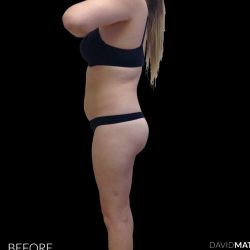 High Def Liposuction Female Before & After Patient #2710