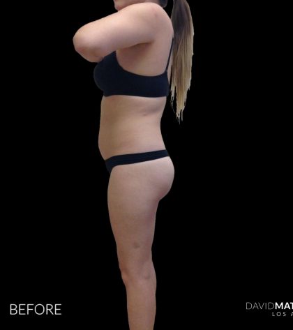 High Def Liposuction Female Before & After Patient #2710
