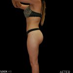 High Def Liposuction Female Before & After Patient #2710