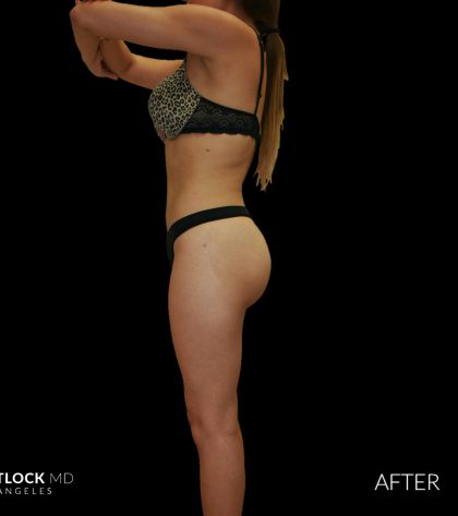 High Def Liposuction Female Before & After Patient #2710