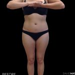 High Def Liposuction Female Before & After Patient #2710
