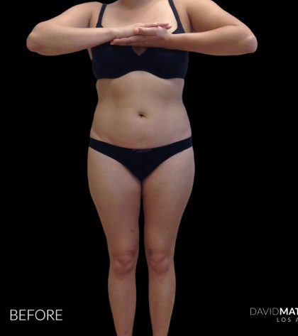 High Def Liposuction Female Before & After Patient #2710