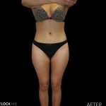 High Def Liposuction Female Before & After Patient #2710