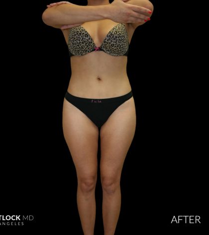 High Def Liposuction Female Before & After Patient #2710