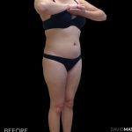 High Def Liposuction Female Before & After Patient #2710
