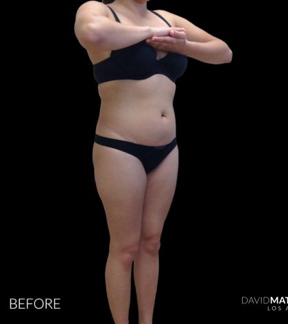 High Def Liposuction Female Before & After Patient #2710