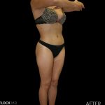 High Def Liposuction Female Before & After Patient #2710