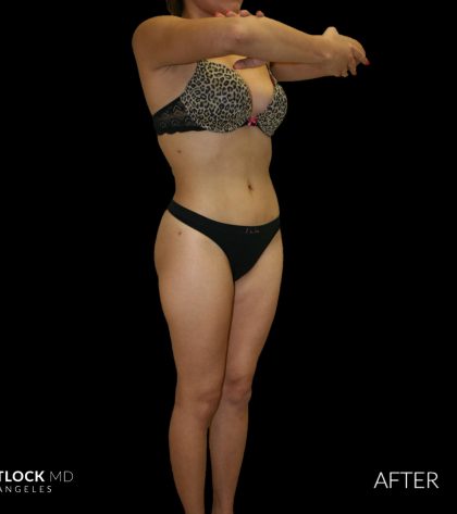 High Def Liposuction Female Before & After Patient #2710