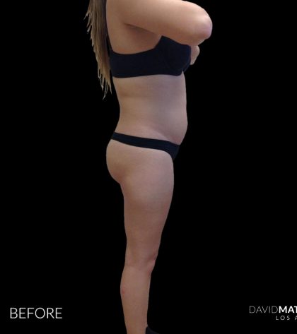 High Def Liposuction Female Before & After Patient #2710