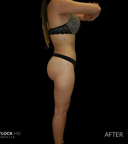 High Def Liposuction Female Before & After Patient #2710