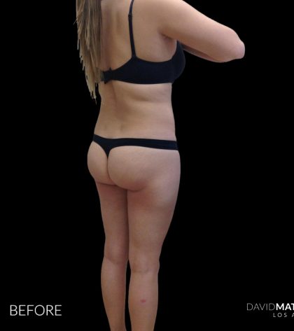 High Def Liposuction Female Before & After Patient #2710
