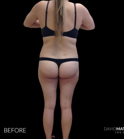 High Def Liposuction Female Before & After Patient #2710