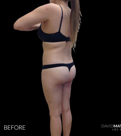 High Def Liposuction Female Before & After Patient #2710