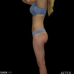 High Def Liposuction Female Before & After Patient #2711