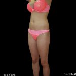 High Def Liposuction Female Before & After Patient #2711